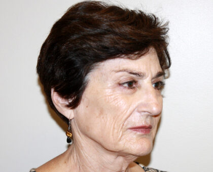 Facelift Before & After Patient #2454