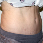 Tummy Tuck Before & After Patient #2618