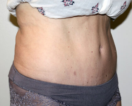 Tummy Tuck Before & After Patient #2618