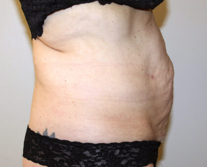 Tummy Tuck Before & After Patient #2618