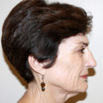 Facelift Before & After Patient #2454