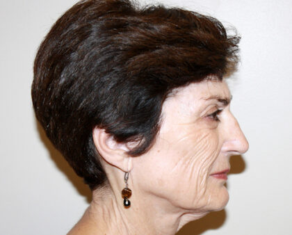 Facelift Before & After Patient #2454