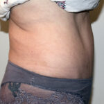 Tummy Tuck Before & After Patient #2618