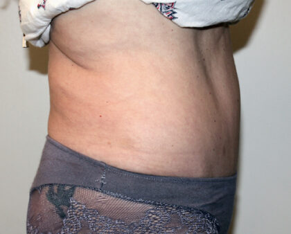 Tummy Tuck Before & After Patient #2618