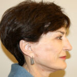 Facelift Before & After Patient #2454