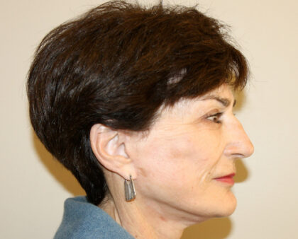 Facelift Before & After Patient #2454