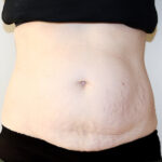 Tummy Tuck Before & After Patient #2639