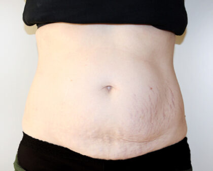 Tummy Tuck Before & After Patient #2639