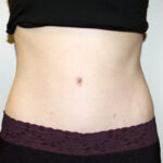 Tummy Tuck Before & After Patient #2639