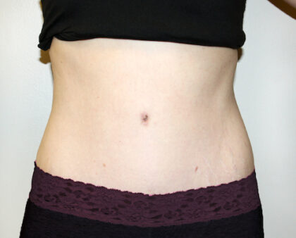 Tummy Tuck Before & After Patient #2639