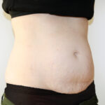 Tummy Tuck Before & After Patient #2639