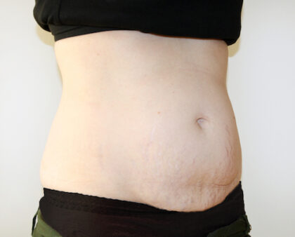 Tummy Tuck Before & After Patient #2639