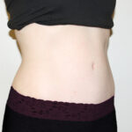 Tummy Tuck Before & After Patient #2639