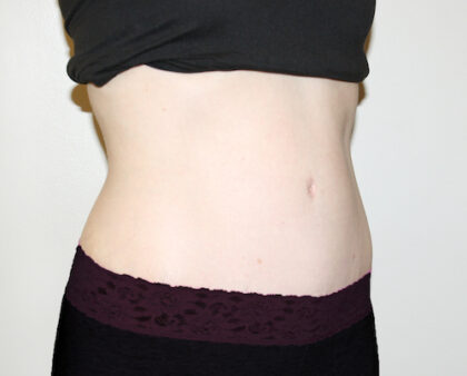 Tummy Tuck Before & After Patient #2639