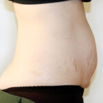 Tummy Tuck Before & After Patient #2639