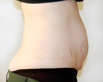 Tummy Tuck Before & After Patient #2639