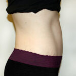 Tummy Tuck Before & After Patient #2639