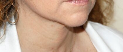 Neck Liposuction Before & After Patient #2513