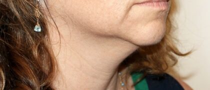 Neck Liposuction Before & After Patient #2513