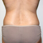Liposuction Before & After Patient #2482