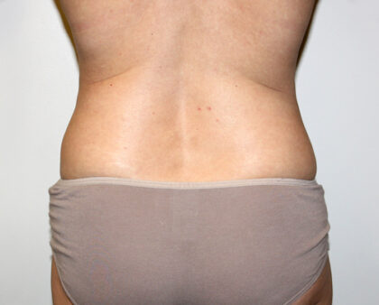 Liposuction Before & After Patient #2482