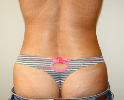 Liposuction Before & After Patient #2482