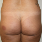 Brazilian Butt Lift Before & After Patient #2299