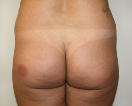 Brazilian Butt Lift Before & After Patient #2299