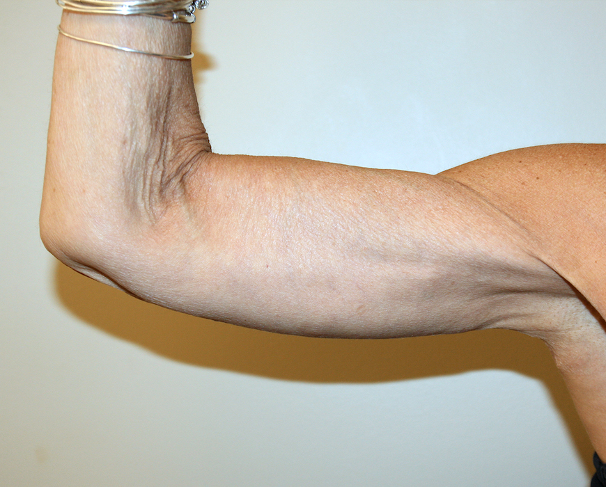 Arm Lift Before & After Patient #2680