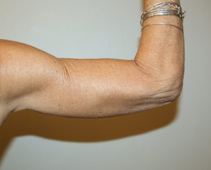 Arm Lift Before & After Patient #2680