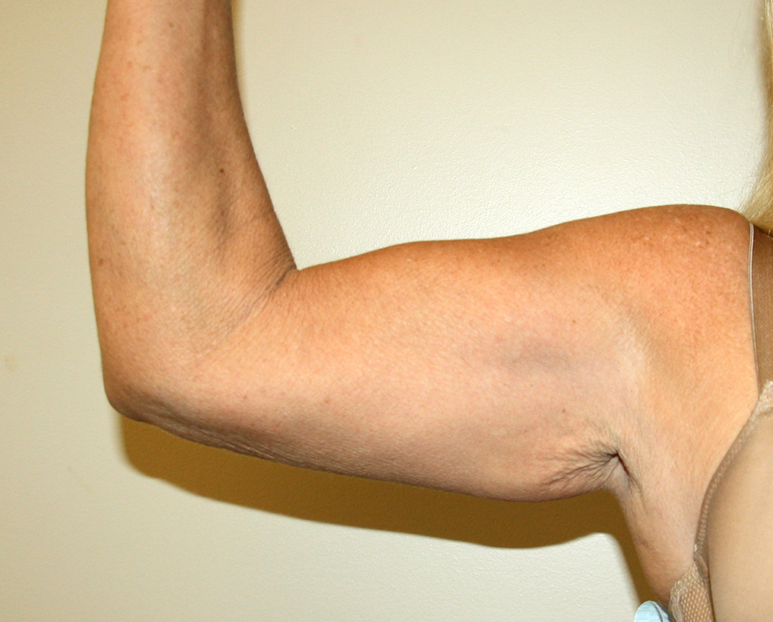 Arm Lift Before & After Patient #2689