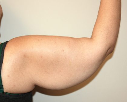 Arm Lift Before & After Patient #2698