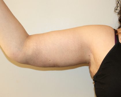 Arm Lift Before & After Patient #2698