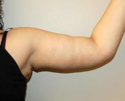 Arm Lift Before & After Patient #2698