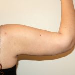 Arm Lift Before & After Patient #2698