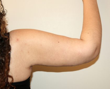 Arm Lift Before & After Patient #2698