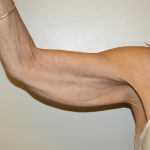 Arm Lift Before & After Patient #2680
