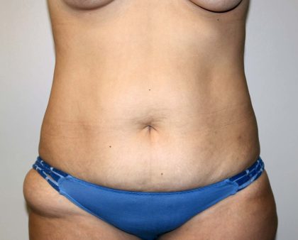 Tummy Tuck Before & After Patient #2977