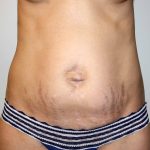 Tummy Tuck Before & After Patient #2921