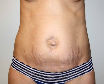Tummy Tuck Before & After Patient #2921