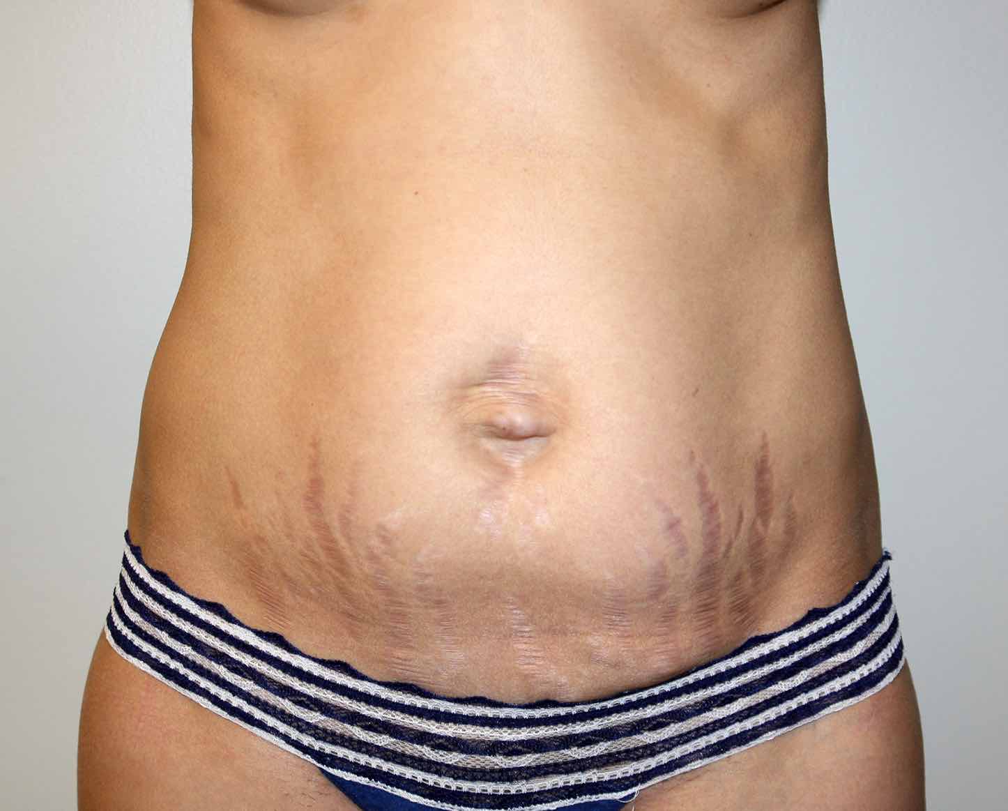 Tummy Tuck Before & After Patient #2921