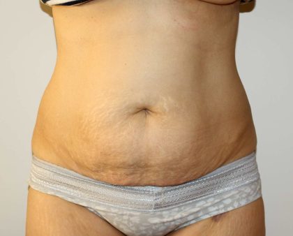 Tummy Tuck Before & After Patient #2935