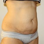 Tummy Tuck Before & After Patient #2935