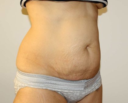 Tummy Tuck Before & After Patient #2935