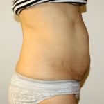 Tummy Tuck Before & After Patient #2935