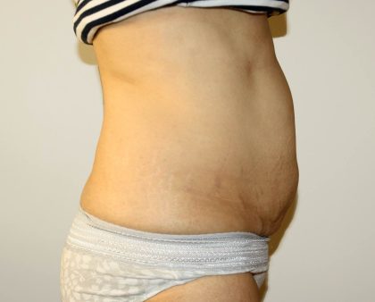 Tummy Tuck Before & After Patient #2935