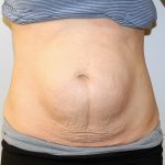 Liposuction Before & After Patient #2963