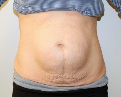 Liposuction Before & After Patient #2963