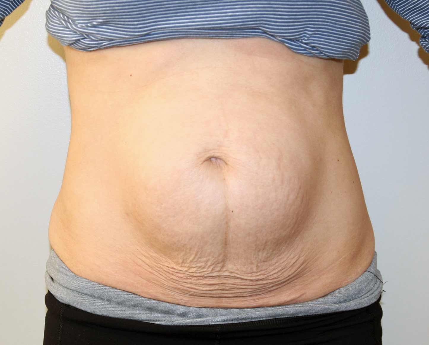 Tummy Tuck Before & After Patient #2963