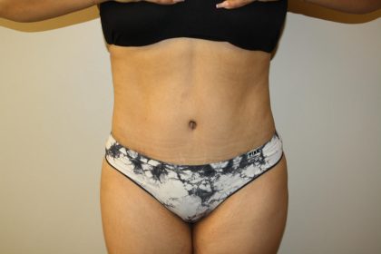 Tummy Tuck Before & After Patient #2998